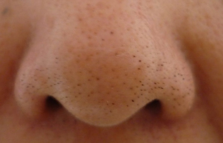 черные точки на носу