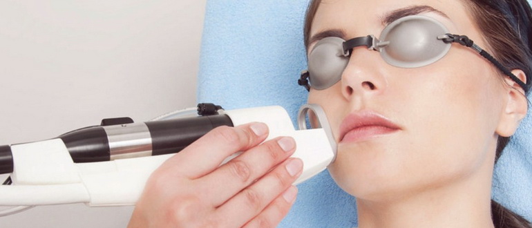 Как правильно проводить лазерную эпиляцию верхней губы у женщин?