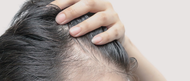 Сильное выпадение волос у женщин: причины