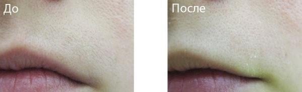 Как правильно проводить лазерную эпиляцию верхней губы у женщин?